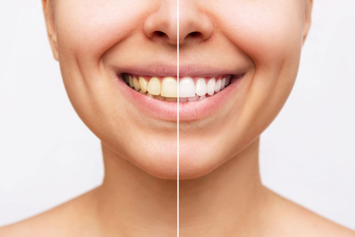 Un sorriso, con metà dei denti sbiancati